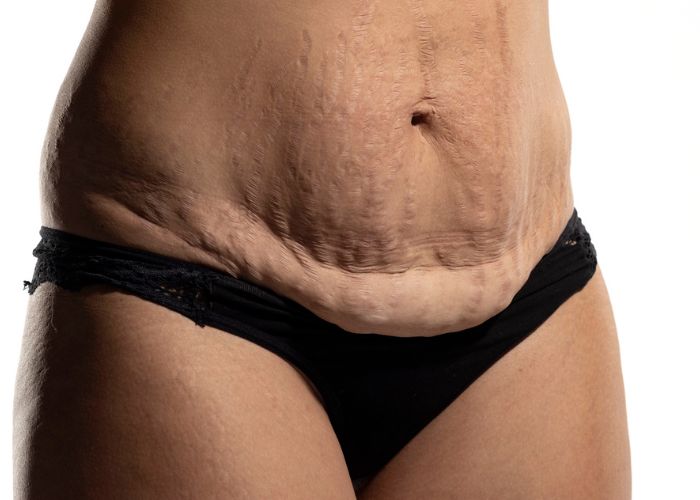 Effective solutions to address sagging skin after weight loss